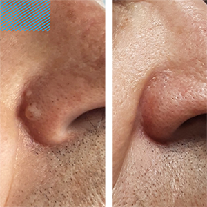 Papules